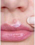 breakout + aid Emergency Dots For Spots and Blemishes tratament topic pentru acnee pe fata decolteu si spate cu ulei din arbore de ceai 72 buc