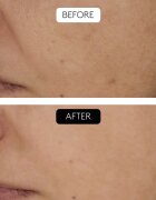 Cocunat Clinical Beauty Filler ser facial anti-îmbătrânire cu terapie cu micro-ace 5 ml