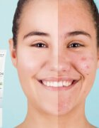 Dermedic Normacne Therapy tratament local impotriva acneei 15 g