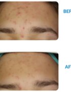 Dermedic Redness Calm crema imptriva rosetii si a vizibilitatii venelor 40 ml