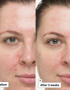 Dr. Jart+ Cicapair™ So Soothing Treatment tratament local de neutralizare a roșeții 30 ml