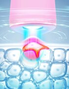 FOREO ESPADA™ 2 stilou cu lumină albastră pentru atenuarea simptomelor acneei Pearl Pink 1 buc