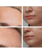 FOREO KIWI™ Derma aparat pentru microdermabraziune cu diamante și curățarea porilor 1 buc