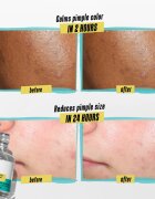Kiehl's Dermatologist Solutions Truly Targeted Blemish-Clearing Solution ser pentru ten acneic pentru femei 15 ml