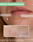 MIXA Anti-Imperfection ser pentru ten acneic 30 ml