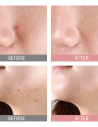 Mizon Good Bye Blemish Pink Spot ser local cu pudră impotriva acneei 19 ml