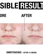 Neutrogena Clear & Defend+ ser facial impotriva acneei 30 ml