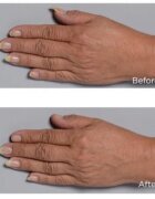 Perricone MD Cold Plasma Plus+ Hand Therapy crema de maini hranitoare 59 ml