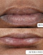 Perricone MD Cold Plasma Plus+ Lip Therapy balsam de buze hidratant 4 ml