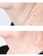Perricone MD Cold Plasma Plus+ Sub-D/Neck Cremă fermitate gât și decolteu 59 ml