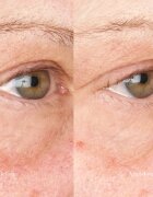 Perricone MD Hypoallergenic Clean Correction Eye Cream hidratare și strălucire pentru pleoape și pungile de sub ochi 15 ml