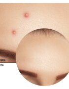 Revox B77 Zitcare AHA BHA PHA Spot Treatment tratament topic pentru acnee 25 ml