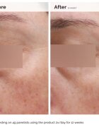 The Ordinary Niacinamide 5% Face & Body Emulsion emulsie hidratantă lejeră impotriva petelor intunecate pentru față și corp 100 ml