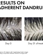 Vichy Dercos Anti-Dandruff set anti matreata