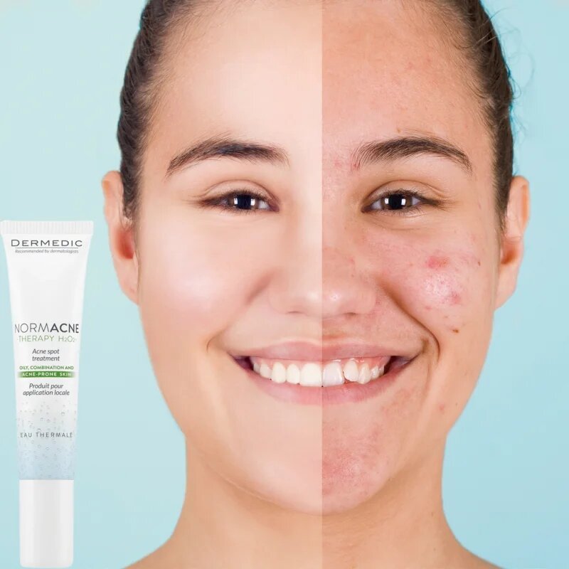 Dermedic Normacne Therapy tratament local impotriva acneei 15 g