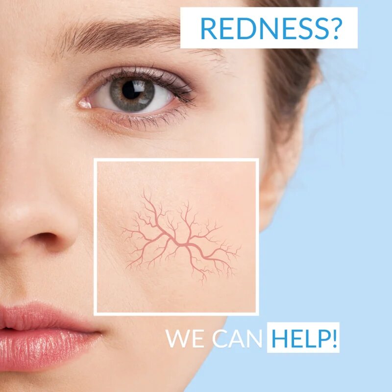Dermedic Redness Calm crema corectoare pentru piele sensibila si inrosita SPF 20 40 ml