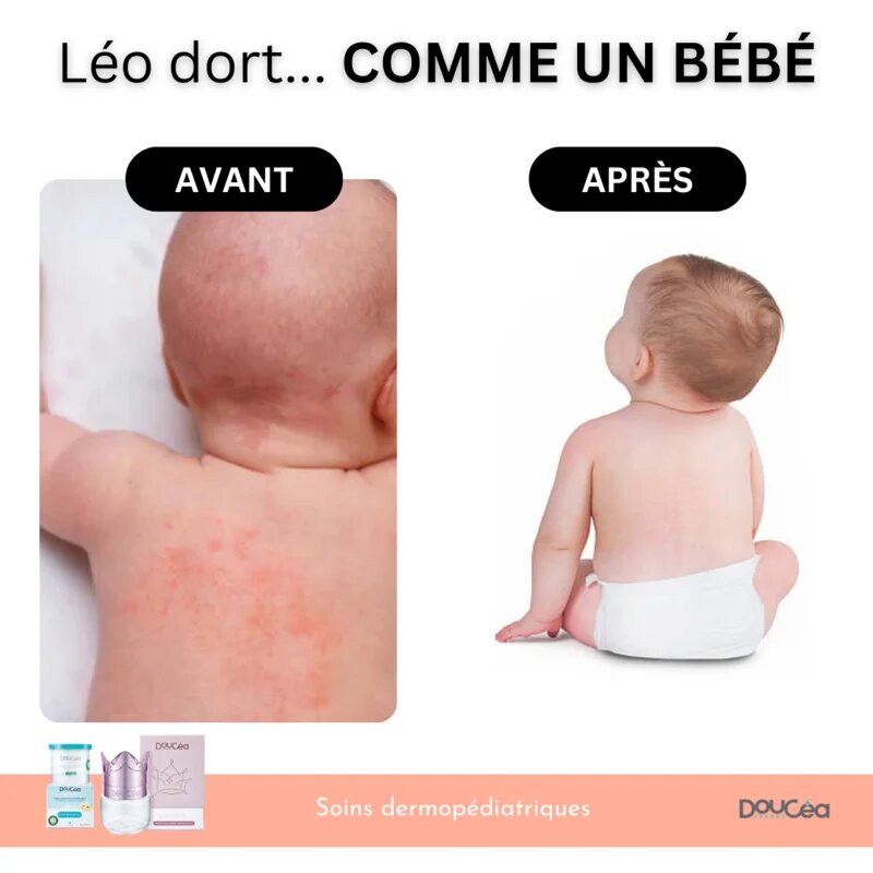 Doucea Doutopia Cream crema de regenerare pentru piele atopica pentru copii si adulti 50 g