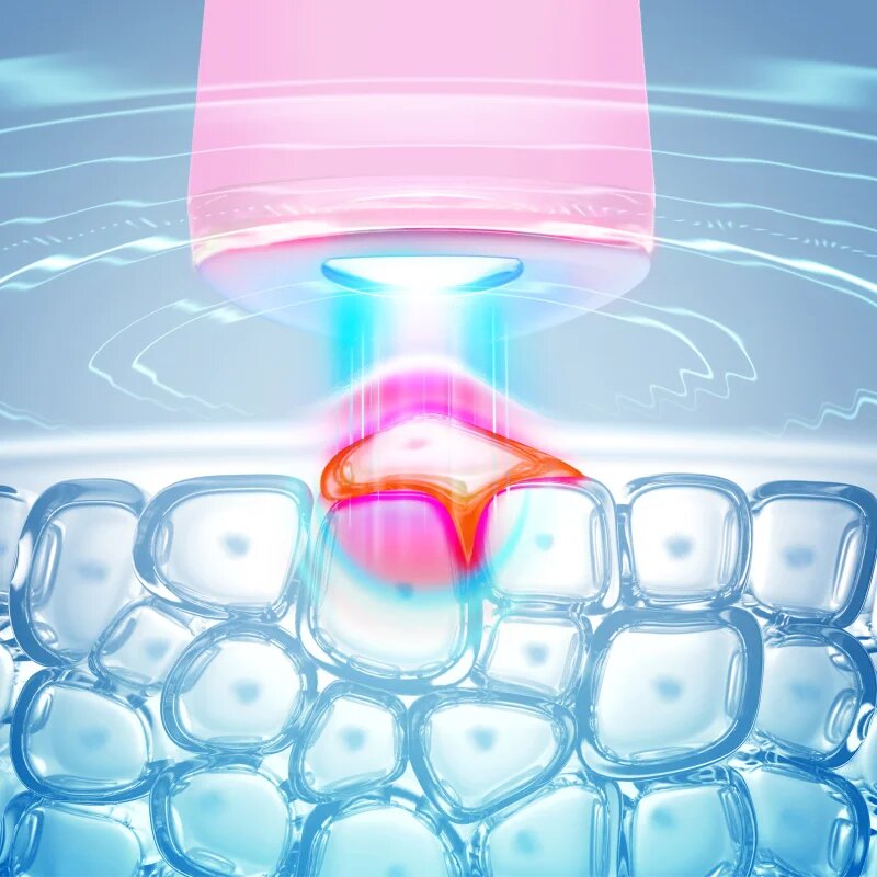 FOREO ESPADA™ 2 stilou cu lumină albastră pentru atenuarea simptomelor acneei Pearl Pink 1 buc