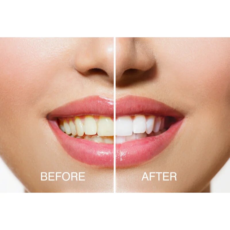 RIO USB teeth whitening Kit pentru albirea dinților